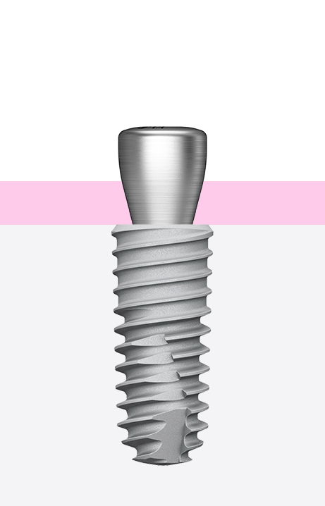 implant-dentar-pasul-2