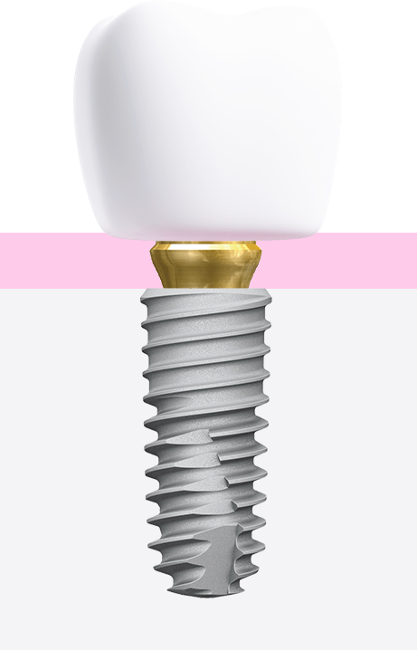 implant-dentar-pasul-3